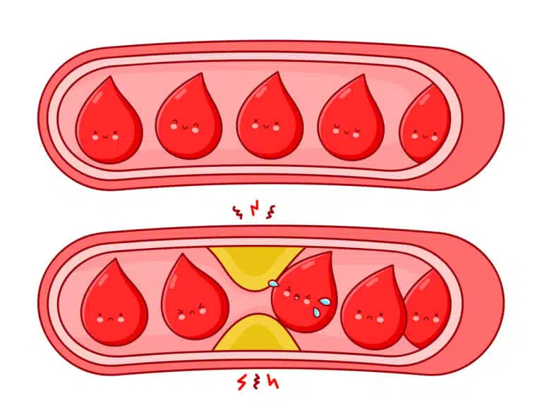 Healthy blood vessels versus clogged blood vessels. Illustration: depositphotos.com