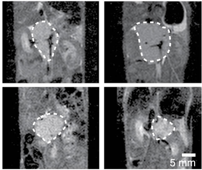 Magnetic resonance imaging of a neuroblastoma cancer model in mice (the tumor tissue is indicated by a dashed line). In the bottom row: after seven days of treatment with sulfofene the tumor shrunk, compared to its growth in the control group (top row)