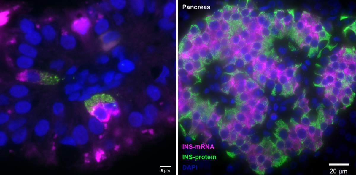 ארגון דומה של תאי ה-FIKL שהתגלו במחקר (משמאל) ושל תאי בטא בלבלב (מימין): מולקולות האר-אן-אי לייצור האינסולין (ורוד-סגלגל) ממוקמות קרוב יותר למרכז התא, בעוד מולקולות האינסולין עצמן (ירוק) מצטברות קרוב לדופן התא ומוכנות להפרשה