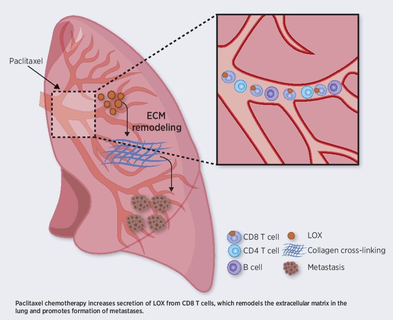 The chemotherapy treatment increases the secretion of LOX from T cells, and as a result the extracellular environment in the lungs changes in a way that encourages the formation of metastases. Photo: Technion spokespeople