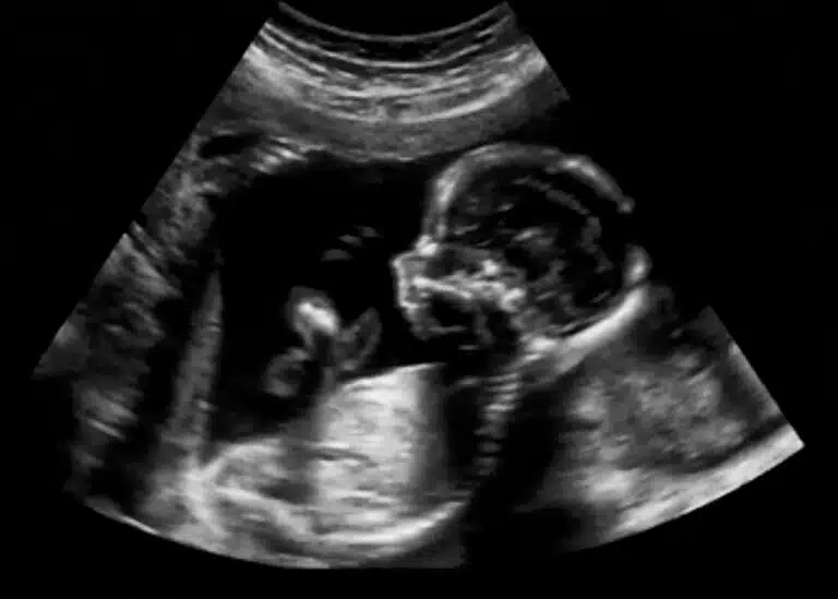 Ultrasound imaging of a four-month-old fetus. Illustration: depositphotos.com