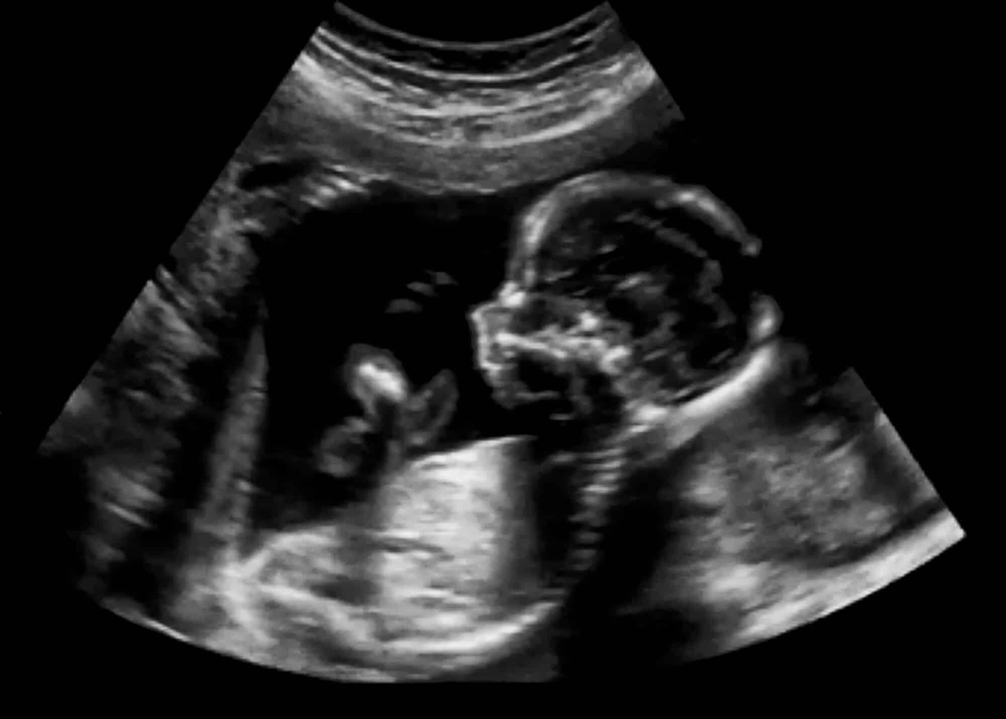 Ultrasound imaging of a four-month-old fetus. Illustration: depositphotos.com
