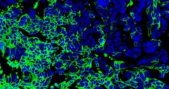 נוגדנים טבעיים לסרטן (ירוק) נקשרים לתאים של סרטן השחלות. גרעיני התאים בכחול. צולם באמצעות מיקרוסקופ קונפוקלי