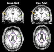 תמונות מוח של בן 35 ובן 85. חצים כתומים מראים את החומר האפור הדק יותר אצל האדם המבוגר. חצים ירוקים מצביעים על אזורים שבהם יש יותר מקום מלא בנוזל השדרתי (CSF) עקב נפח מוחי מופחת. העיגולים הסגולים מדגישים את חדרי המוח, המלאים ב- CSF. אצל מבוגרים, אזורים מלאים בנוזלים אלה הם הרבה יותר גדולים. קרדיט: ג'סיקה ברנרד