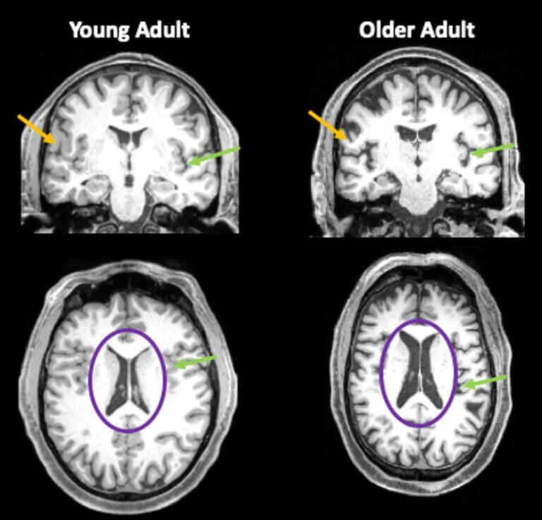 Brain images of a 35-year-old and an 85-year-old. Orange arrows show the thinner gray matter in the older person. Green arrows indicate areas where there is more space filled with cerebrospinal fluid (CSF) due to reduced brain volume. The purple circles highlight the ventricles of the brain, which are filled with CSF. In adults, these fluid-filled areas are much larger. Credit: Jessica Barnard