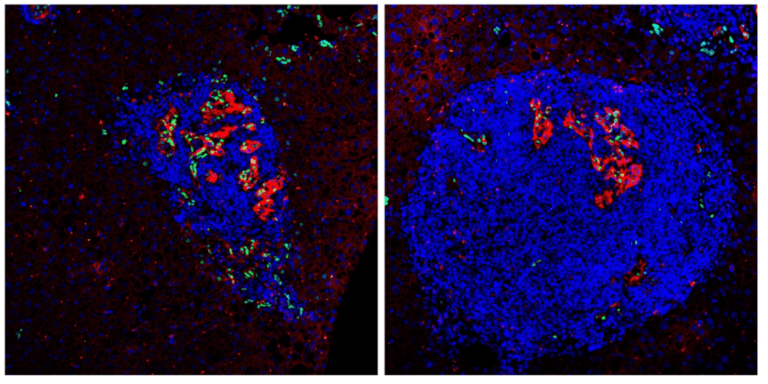 Right: Immune clusters in the liver of a mouse containing ILCs, and within them cancer cells (in red). On the left: immune clusters in the liver of a mouse from which ILCs have been removed, and within them cancer cells. The cancer cells thrive more in the mouse liver which contains ILCs