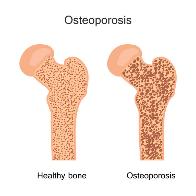 Osteoporosis. Illustration: depositphotos.com