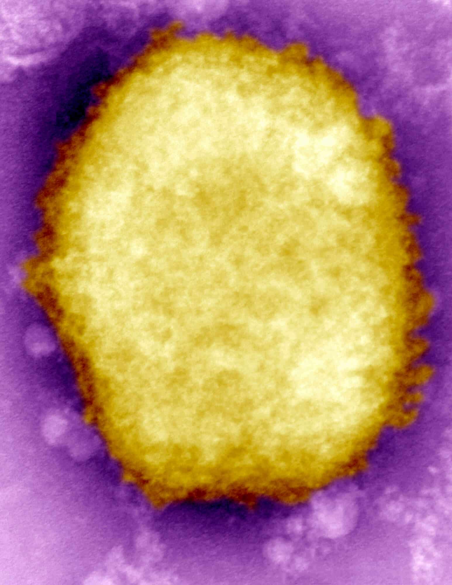 Monkeypox virus in human vesicular fluid. Electron microscopy reveals "M" virus (Mulberry type) of varicella virus in human vesicular fluid. The surface of type "M" viruses is covered with short, coiled filaments, while type "C" or "capsule" viruses have penetrated inside. Photo: depositphotos.com