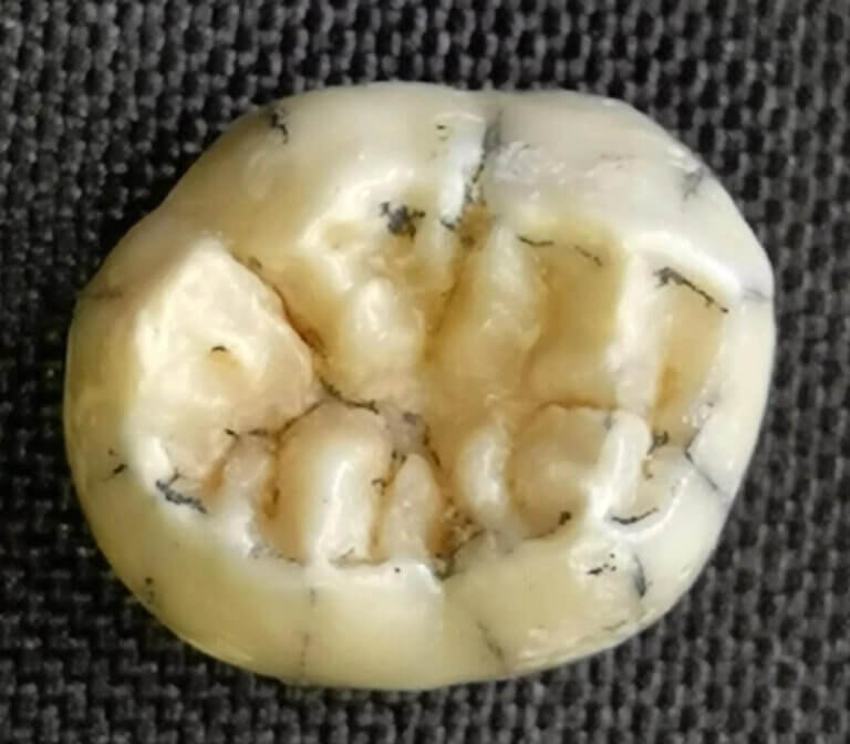 Close-up of a tooth of a Denisovan girl. Credit: Fabrice Demeter (University of Copenhagen/CNRS Paris)