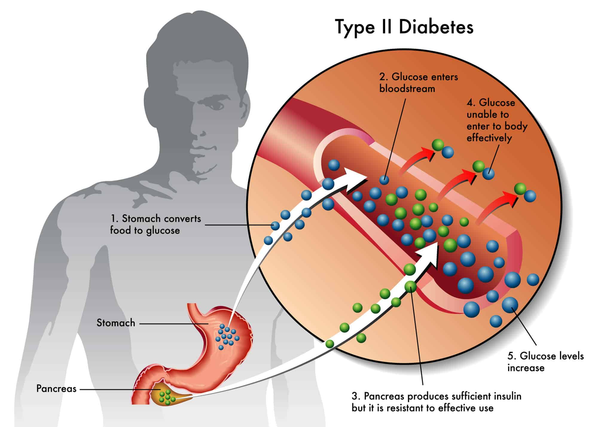 Type 2 diabetes . Image: depositphotos.com