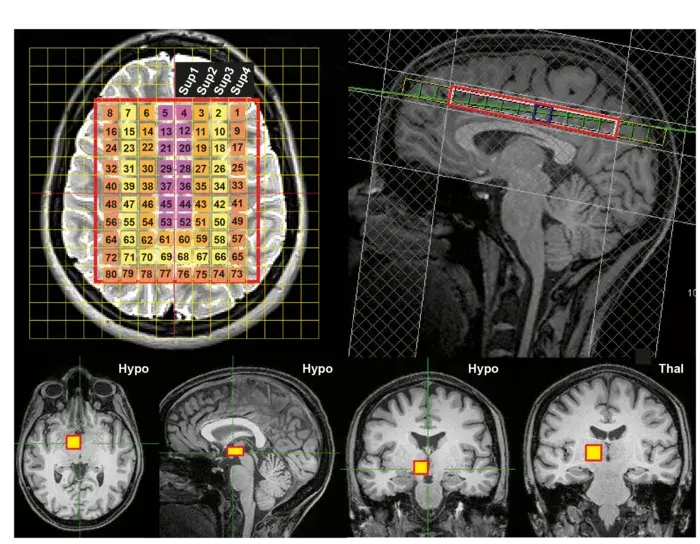 אזורים במוח שנבחרו למדידת טמפרטורה באמצעות ספקטרוסקופיית תהודה מגנטית מוצגים כשכבות על סקירות MSR רגילות של המוח במישורים שונים. 80 אזורים נבחרו במוח הגדול (מוצגים במבט מלמעלה, למעלה משמאל, ובמבט מהצד, למעלה מימין) וקובצו בארבע שכבות קונצנטריות (למעלה משמאל). אזור אחד נבחר בהיפותלמוס (Hypo, מוצג במבט מלמעלה, מהצד ומלפנים, למטה משמאל למרכז) ואזור אחד מהתלמוס (Thal, מוצג במבט מלפנים, למטה מימין). ההיפותלמוס הוא אזור חשוב בוויסות של דברים רבים כולל טמפרטורה, שינה ושעון ביולוגי. קרדיט: Nina Rzechorzek/Edinburgh Imaging/Brain