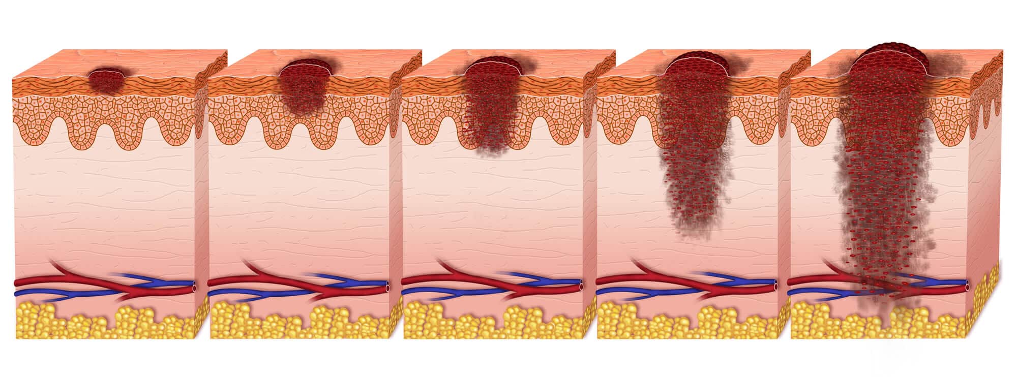 Development of melanoma skin cancer.  Image: depositphotos.com