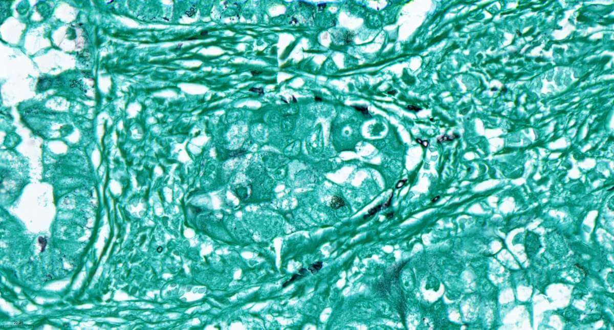 תאים פטרייתיים (בשחור) בתוך רקמה סרטנית בריאות (בטורקיז). באופן שאינו שכיח, הפטריות התגלו מחוץ לתאי הגידול. תצלום: ליאן נרונסקי-חזיזה וננסי גברט