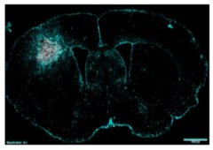 גידול גליובסטומה במוח - הגידול מסומן בלבן, האסטרוציטים מסומנים בכחול. קרדיט: אוניברסיטת תל אביב