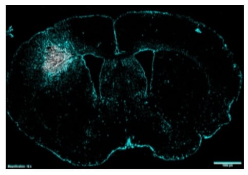 Tumeur du glioblastome dans le cerveau - la tumeur est marquée en blanc, les astrocytes sont marqués en bleu.  Crédit : Université de Tel-Aviv