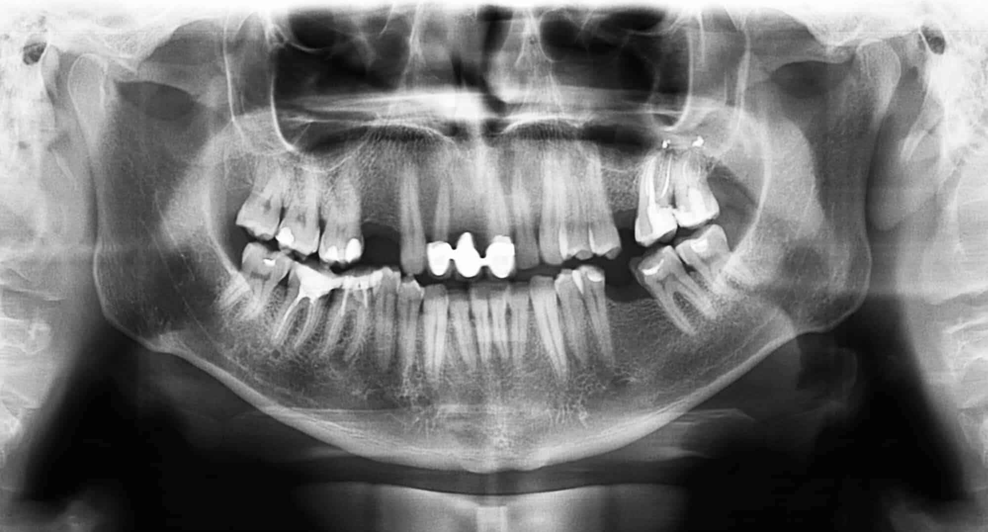 X-ray of teeth and jaw. Image: depositphotos.com