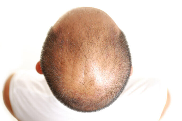 balding. Image: depositphotos.com