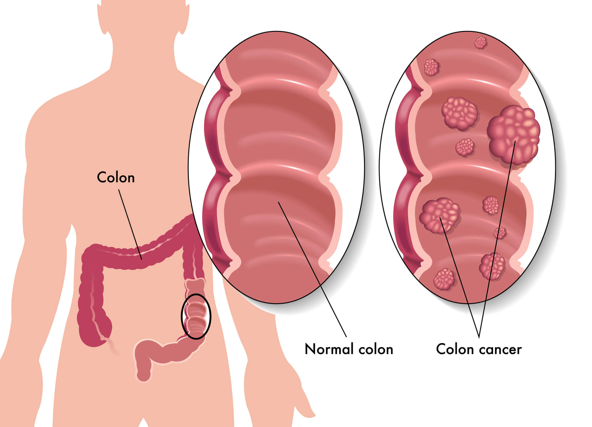 Colorectal Cancer. Image: depositphotos.com