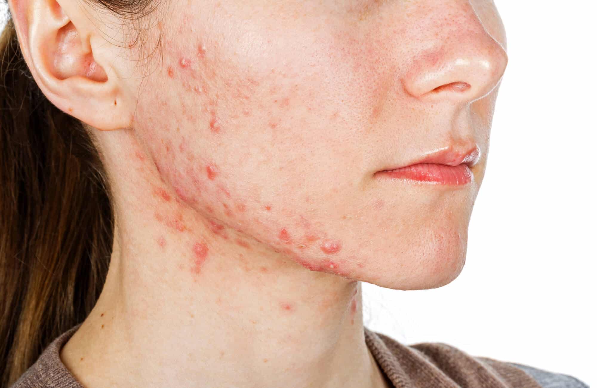 Acne (pimples). Illustration: depositphotos.com