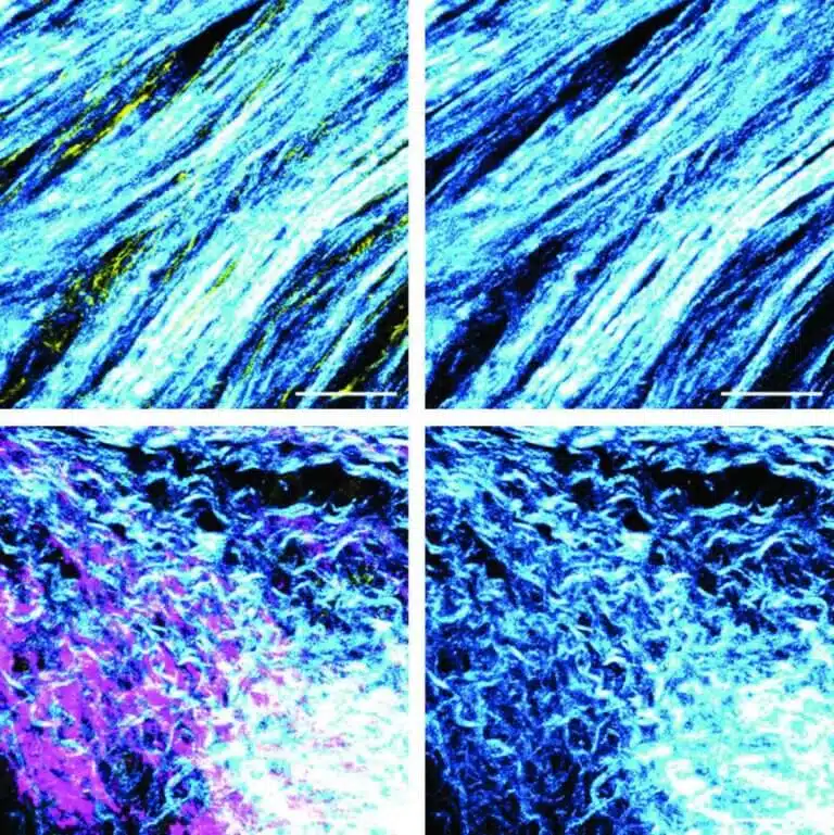 Microscope image of the fibers produced by the fibroblasts in the cancerous tumor environment. Above: orderly fibers in samples taken from pancreatic cancer patients with a normal BRCA gene, below: branched fibers in samples from patients carrying a mutation in the gene