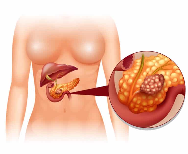 Pancreatic cancer. Illustration: depositphotos.com