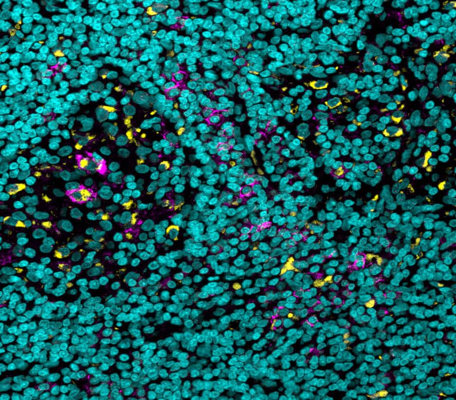 Cells of the immune system (in yellow) expressing the "brake pedal" (the FcgIIb receptor, in purple) on their surface in a tissue sample of a rare and aggressive type of skin cancer; In blue - cell nuclei