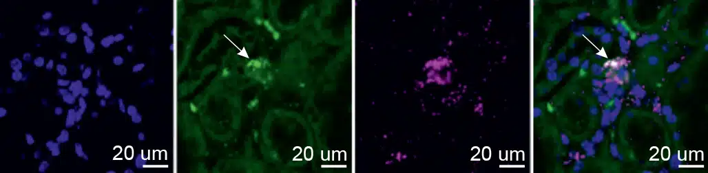 התאים האבודים של ה-EPO: תמונות מיקרוסקופ של דגימת כליה שהוצאה מאדם שמת משאיפת עשן (הרעלת פחמן חד-חמצני). בכחול – גרעיני תאים בכליה, בירוק – ההורמון אריתרופויאטין, ובסגול – תאי הסיב (פיברובלסטים) ברקמה; מימין: איחוד הסמנים השונים חושף את תאי הנורן – יצרני ה-EPO שהתגלו במחקר (מסומנים בחיצים לבנים)