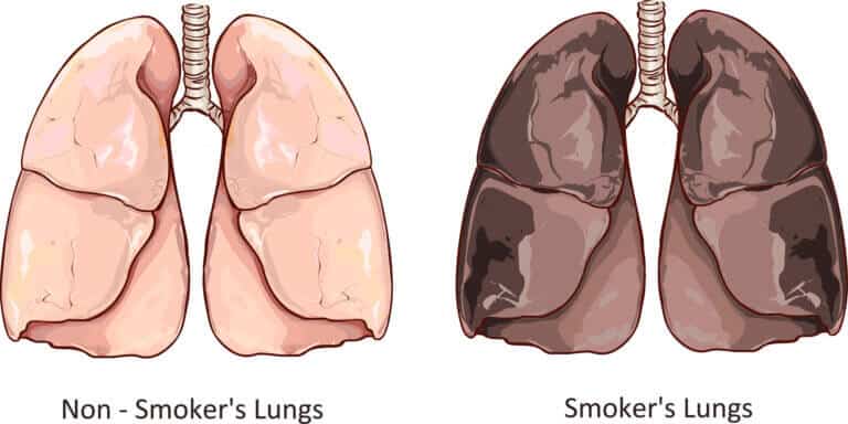 ריאה של מעשן בהשוואה לריאה נקיה. המחשה: depositphotos.com