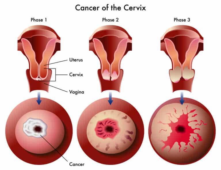 Ovarian cancer. Illustration: depositphotos.com