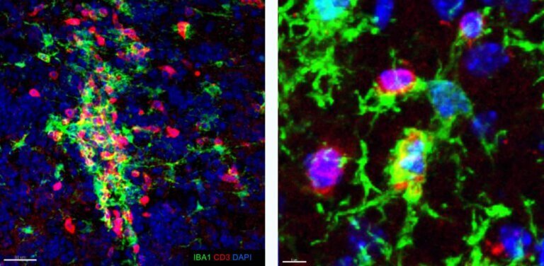Clusters of microglial cells (in green) and T cells (in red) in the brain of a mouse with MS-like disease (left: general view, right: close-up)