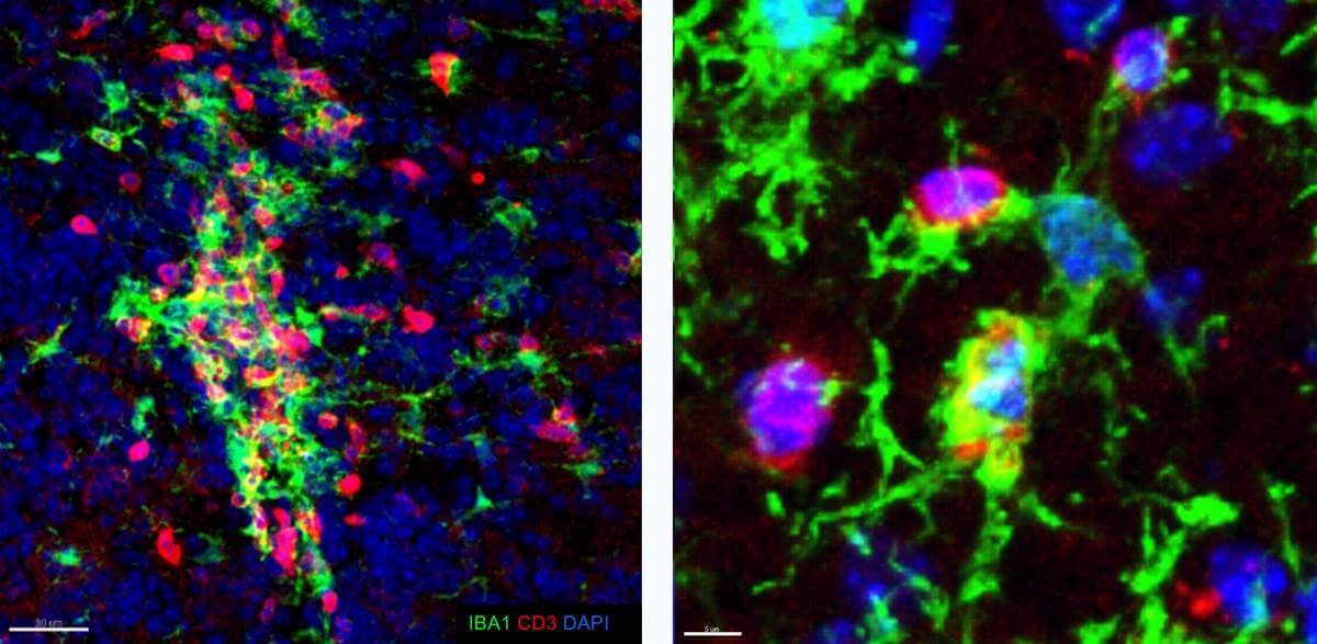 مجموعات من الخلايا الدبقية الصغيرة (باللون الأخضر) والخلايا التائية (باللون الأحمر) في دماغ فأر مصاب بمرض يشبه مرض التصلب العصبي المتعدد (يسار: منظر عام، يمين: صورة مقربة)