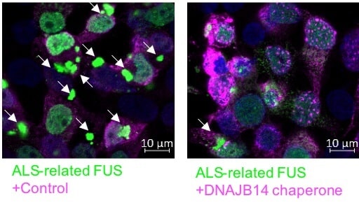 Left: cells with a mutant FUS protein that causes accumulations (in green) and leads to ALS disease. Right: the cells with the protein/chaferon (in pink) that manages to prevent the accumulations