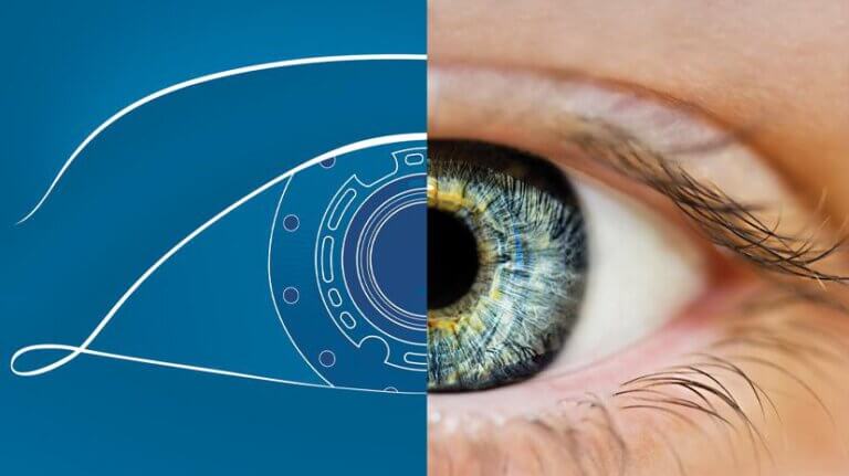 Kornit Vision's artificial cornea. PR photo