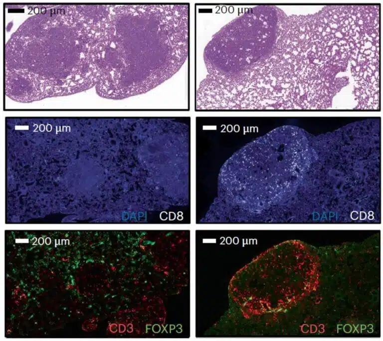 الأنسجة المأخوذة من الفئران المزروعة بخلايا سرطان الرئة المصممة لإنتاج كميات عالية من PSME4 (العمود الأيسر) أو الخلايا السرطانية غير المعدلة (العمود الأيمن). عندما يتم التعبير عن البروتين بكمية عالية، يكون الورم أكبر (الصف العلوي، يتم تمييز الخلايا السرطانية باللون الأرجواني المكثف والمركز)، ويكون عدد الخلايا التائية التي يمكنها محاربة الورم أقل (الصف الأوسط، باللون الأبيض)، وهناك المزيد من الخلايا التي تقمع الاستجابة المناعية (الصف السفلي، باللون الأخضر)