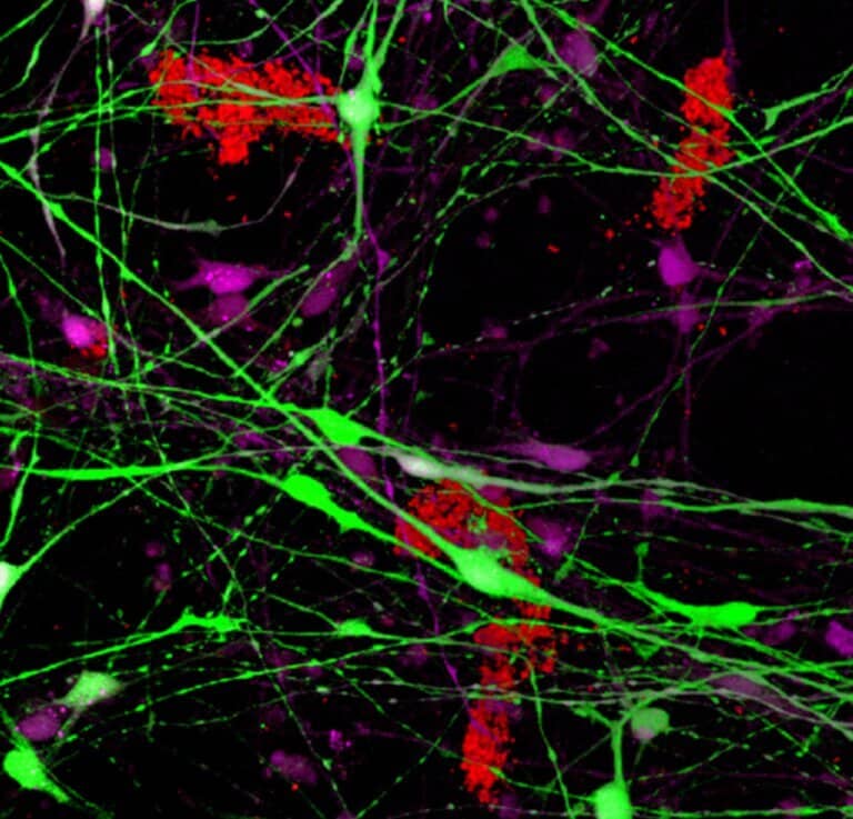 scientific picture. A XNUMXD model system of human neurons in a dish. In green and purple: nerve cells expressing a protein that is defective in the ubiquitin system. As a result of this expression, the pathology that characterizes Alzheimer's patients is created - the formation of amyloid clusters (in red) outside the cells