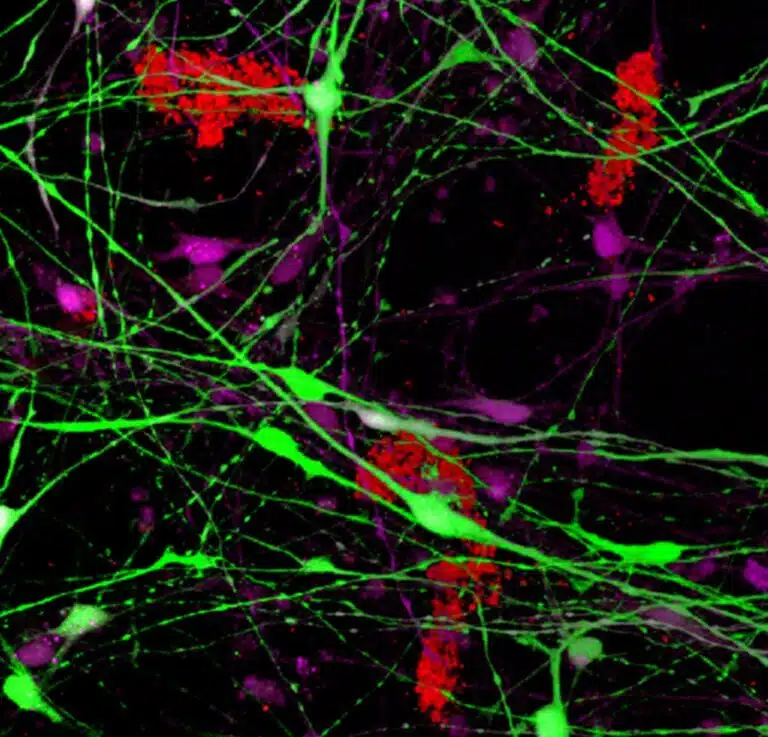 الصورة العلمية. نظام نموذجي ثلاثي الأبعاد للخلايا العصبية البشرية في طبق. باللون الأخضر والأرجواني: الخلايا العصبية التي تعبر عن بروتين معيب في نظام اليوبيكويتين. ونتيجة لهذا التعبير، يتم إنشاء علم الأمراض الذي يميز مرضى الزهايمر - تشكيل مجموعات الأميلويد (باللون الأحمر) خارج الخلايا