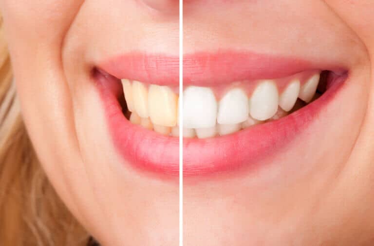 Teeth Whitening. Illustration: depositphotos.com