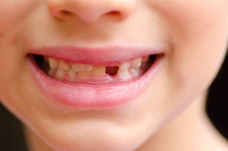 Milk teeth in children. Illustration: depositphotos.com