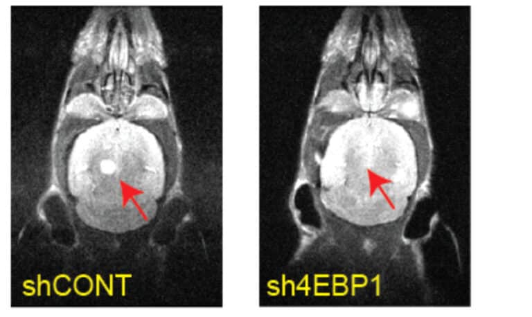 תאי סרטן המוח. מימין: תאים שהושתק בהם הגן המקודד ל4EBP שלא הצליחו להצמיח גידול, משמאל: תאי הביקורת שמזהים בהם גידול. קרדיט: ד"ר טל לוי