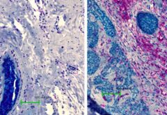 חתך מרקמת שד של חולת סרטן שד טריפל נגטיב (TNBC), מימין, ורקמת שד בריאה, משמאל. בחולת הסרטן, תאי הסרטן (מסומנים בתכלת) מקיפים תאים במיקרו-סביבה שלהם המבטאים רמה גבוהה של CD84 (מסומנים בסגול)