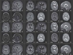 Magnetic resonance imaging (MRI) findings of the brain in three children with a missing copy of Chaser. Scans taken at 8 months or 4 years of age (top row) show structural changes in the brain: shrunken frontal regions, a relatively small brainstem (indicated by asterisks), and abnormal development of the nerve sheath (myelin) in deep areas of the brain (indicated by arrows). These changes were barely visible in scans taken at XNUMX month of age (bottom row)