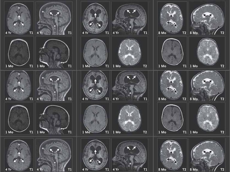 ממצאי דימות תהודה מגנטית (MRI) של המוח בשלושה ילדים עם עותק חסר של צ'ייסר. הסריקות שנעשו בגיל 8 חודשים או 4 שנים (שורה עליונה) מעידות על שינויים מבניים במוח: אזורים קדמיים שהצטמקו, גזע מוח קטן יחסית (מסומן בכוכביות), והתפתחות לא תקינה של מעטפת העצבים (מיאלין) באזורים עמוקים במוח (מסומנת בחיצים). שינויים אלה כמעט שלא נראו בסריקות מגיל חודש (שורה תחתונה)