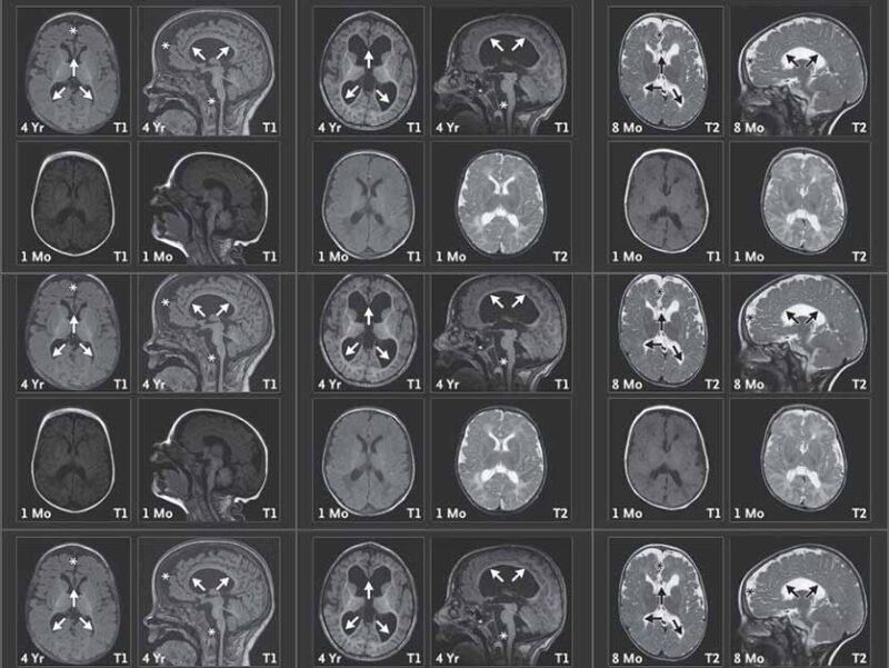 ממצאי דימות תהודה מגנטית (MRI) של המוח בשלושה ילדים עם עותק חסר של צ'ייסר. הסריקות שנעשו בגיל 8 חודשים או 4 שנים (שורה עליונה) מעידות על שינויים מבניים במוח: אזורים קדמיים שהצטמקו, גזע מוח קטן יחסית (מסומן בכוכביות), והתפתחות לא תקינה של מעטפת העצבים (מיאלין) באזורים עמוקים במוח (מסומנת בחיצים). שינויים אלה כמעט שלא נראו בסריקות מגיל חודש (שורה תחתונה)