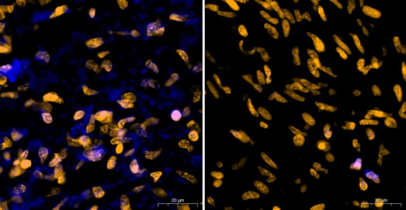 רקמת גידול סרטני מסוג גליובלסטומה שהוצאה מחולה ומיד הושרתה בתמיסה המכילה חומצה אמינית שרק חיידקים צורכים. ניתן לראות משמאל כי התאים הסרטניים שגרעיניהם מסומנים בכתום קלטו את החומצה האמינית המסומנת בכחול – עדות לקיומם של חיידקים חיים ופעילים בגידול. מימין, לאחר טיפול באנטיביוטיקה, צריכת החומצה האמינית נפסקה