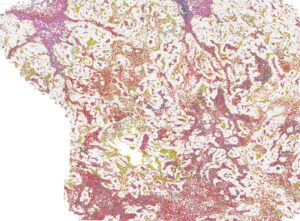 نسيج سرطان الرئة البشري تحت المجهر. تُحاط الخلايا البلعمية المساعدة (باللون الأحمر) بإنزيمات (باللون الأصفر) تُنشّط الجزء المُحفّز من الأجسام المضادة التي تُنتجها. هذا التأثير المُوجَّه يمنع تلف الأنسجة السليمة.