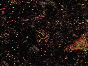 نسيج سرطان الرئة البشري تحت المجهر. تُحاط الخلايا البلعمية المساعدة (باللون الأحمر) بإنزيمات (باللون الأصفر) تُنشّط الجزء المُحفّز من الأجسام المضادة التي تُنتجها. هذا التأثير المُوجَّه يمنع تلف الأنسجة السليمة.