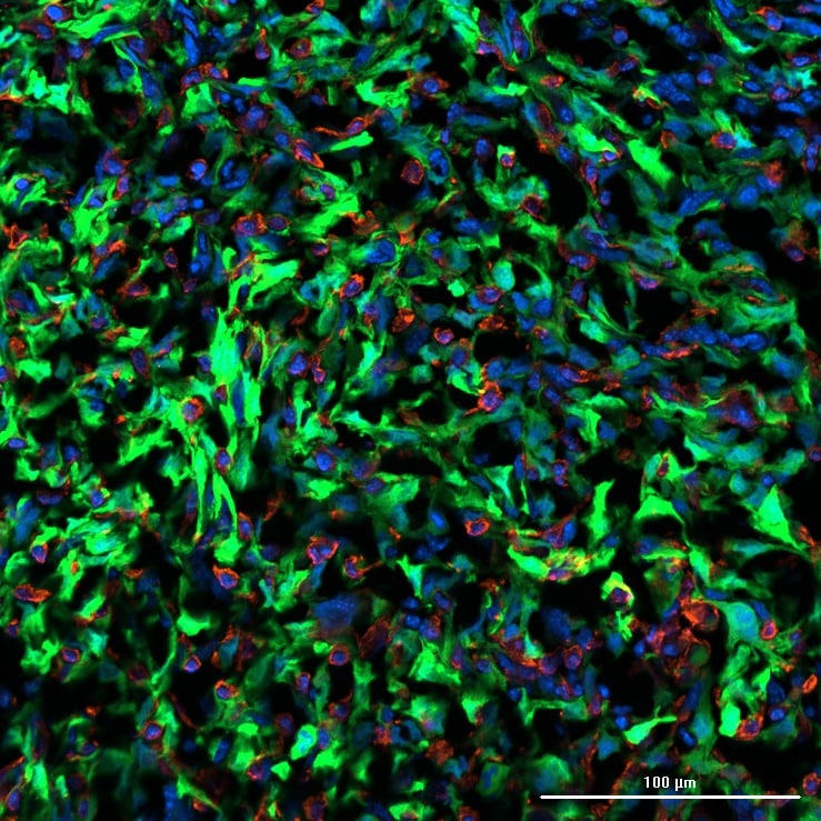 פוענח המנגנון שמאפשר לסרטן השד לשלוח גרורות למוח. באדיבות החוקרים