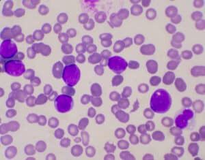 Silencing the IPO11 gene inhibits acute leukemia cells in culture and in mice