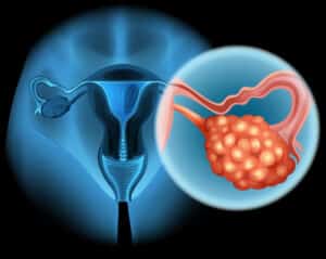 Blood test may predict which ovarian tumors will respond to chemotherapy