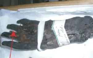 تُظهر الصورة إحدى عينات المومياء، من متحف بريستول، المستخدمة في الدراسة. يشير السهم الأحمر إلى موضع أخذ عينة الضمادة من إصبع يد المومياء الأنثوية. حقوق الصورة: كاثرين كلارك، إحدى مؤلفات الدراسة.